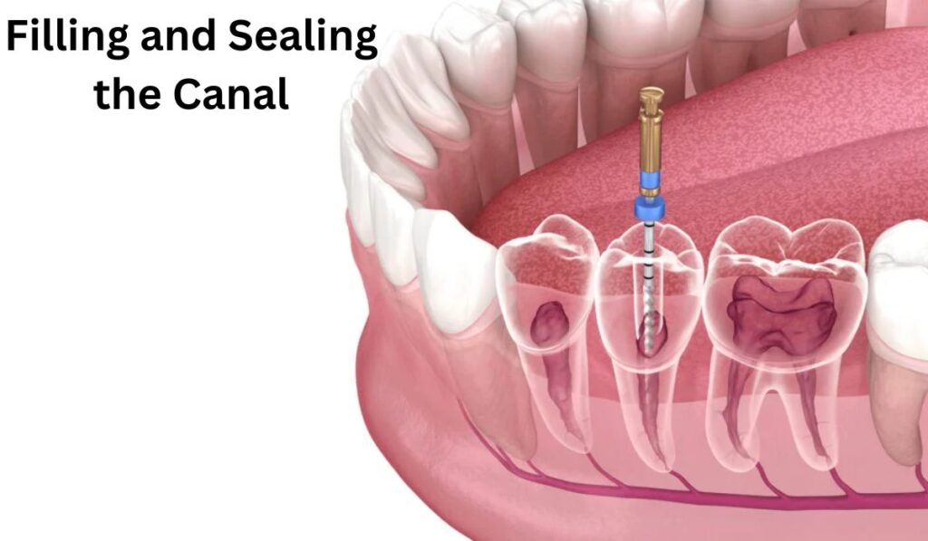 Filling and Sealing the Canal