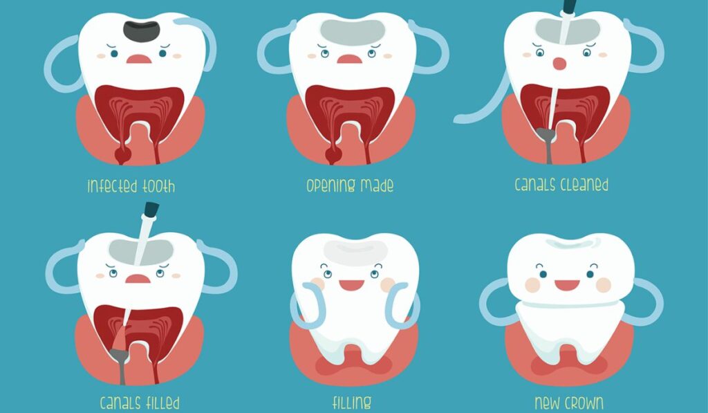 Long Does a Root Canal Take