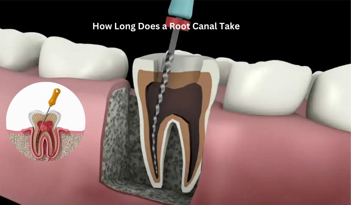 How Long Does a Root Canal Take